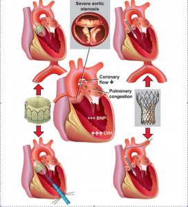 Trans catheter aortic valve implantation (TAVI) | Cardiac Health