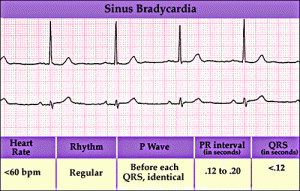 Bradycardia | Cardiac Health