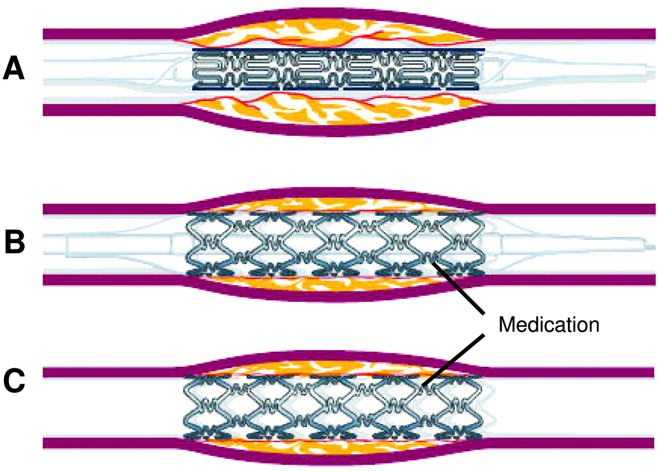 How long does a heart stent last? Do they need to be