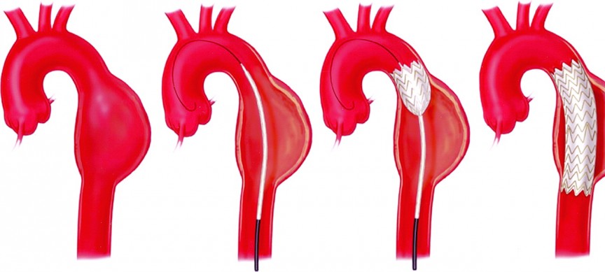 Thoracic Aortic Aneurysms | Cardiac Health