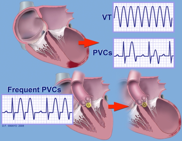 Premature Ventricular Contractions Cardiac Health