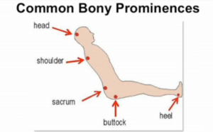 Pressure Injuries | Cardiac Health