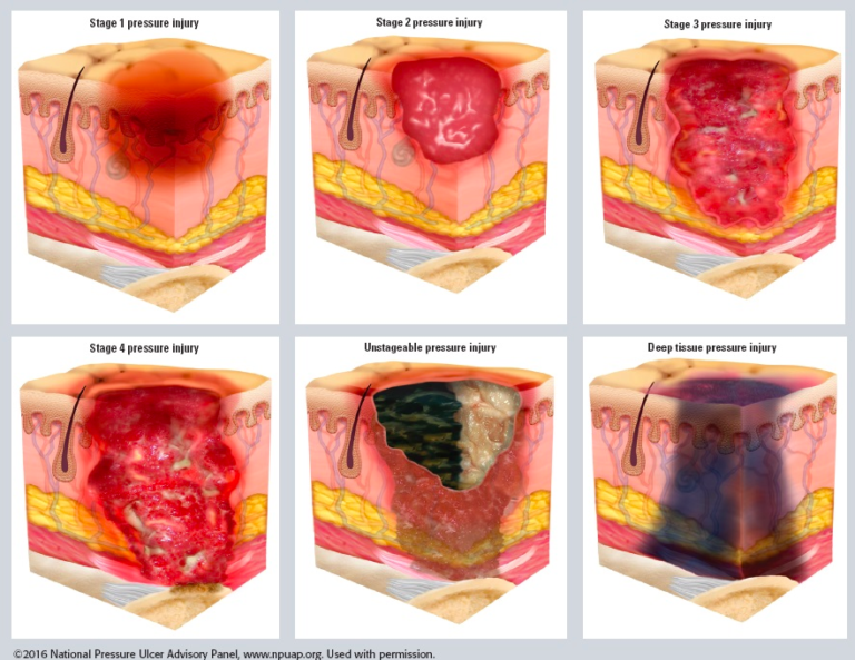 Pressure Injuries Cardiac Health